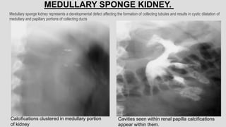 Calcifications clustered in medullary portion
of kidney
Cavities seen within renal papilla calcifications
appear within them.
MEDULLARY SPONGE KIDNEY.
Medullary sponge kidney represents a developmental defect affecting the formation of collecting tubules and results in cystic dilatation of
medullary and papillary portions of collecting ducts
 
