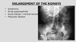 • lymphoma
• Acute pyelonephritis
• Acute tubular / cortical necrosis
• Polycystic disease
ENLARGEMENT OF THE KIDNEYS
 
