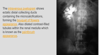 The intravenous pyelogram shows
ectatic distal collecting ducts
containing the microcalcifications,
forming the bouquet of flowers
appearance. Also dilated contrast-filled
tubules within the renal medulla which
is known as the paintbrush
appearance.
 