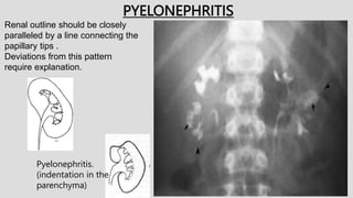 PYELONEPHRITIS
Renal outline should be closely
paralleled by a line connecting the
papillary tips .
Deviations from this pattern
require explanation.
Pyelonephritis.
(indentation in the
parenchyma)
 