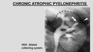 With dilated
collecting system.
CHRONIC ATROPHIC PYELONEPHRITIS
 