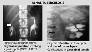 Intravenous urogram shows
calyceal amputation involving
superior pole (MOTH EATEN
RENAL TUBERCULOSIS
Calyceal dilatation in lower pole
and loss of parenchyma.
Calcifications in paraspinal lymph
 