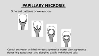 PAPILLARY NECROSIS:
Central excavation with ball-on-tee appearance lobster claw appearance ,
signet ring appearance , and sloughed papilla with clubbed calix
Different patterns of excavation
 