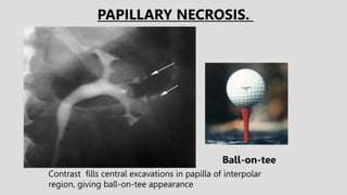 Contrast fills central excavations in papilla of interpolar
region, giving ball-on-tee appearance
Ball-on-tee
PAPILLARY NECROSIS.
 