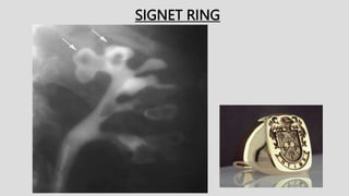 SIGNET RING
 