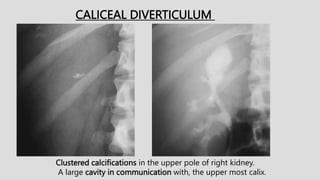 Clustered calcifications in the upper pole of right kidney.
A large cavity in communication with, the upper most calix.
CALICEAL DIVERTICULUM
 