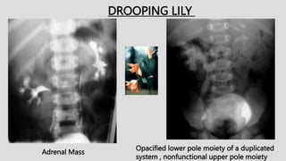 DROOPING LILY
Opacified lower pole moiety of a duplicated
system , nonfunctional upper pole moiety
Adrenal Mass
 