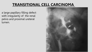 a large papillary filling defect
with irregularity of the renal
pelvis and proximal ureteral
lumen.
TRANSITIONAL CELL CARCINOMA
 