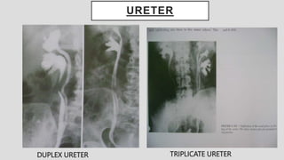 URETER
TRIPLICATE URETER
DUPLEX URETER
 