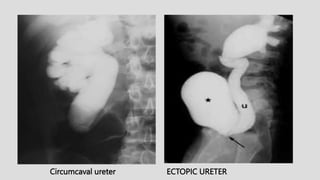 Circumcaval ureter ECTOPIC URETER
 