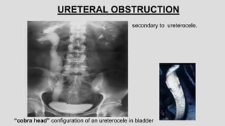 “cobra head” configuration of an ureterocele in bladder
URETERAL OBSTRUCTION
secondary to ureterocele.
 