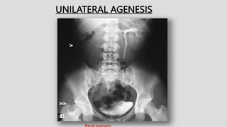 UNILATERAL AGENESIS
 