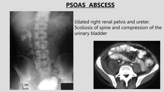 Dilated right renal pelvis and ureter.
Scoliosis of spine and compression of the
urinary bladder
PSOAS ABSCESS
 