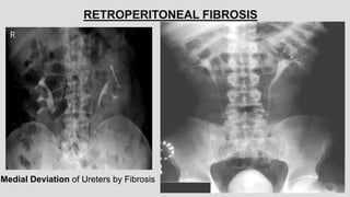 RETROPERITONEAL FIBROSIS
Medial Deviation of Ureters by Fibrosis
 
