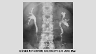 Multiple filling defects in renal pelvis and ureter TCC
 