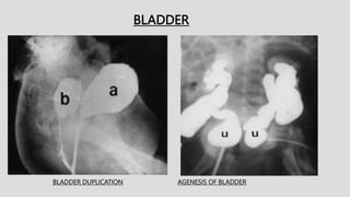 BLADDER DUPLICATION
BLADDER
AGENESIS OF BLADDER
 