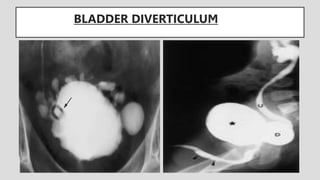 BLADDER DIVERTICULUM
 