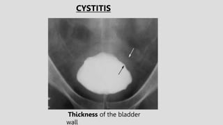 Thickness of the bladder
wall
CYSTITIS
 