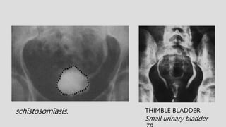 THIMBLE BLADDER
Small urinary bladder
schistosomiasis.
 