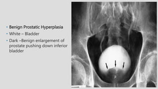 • Benign Prostatic Hyperplasia
• White – Bladder
• Dark –Benign enlargement of
prostate pushing down inferior
bladder
 