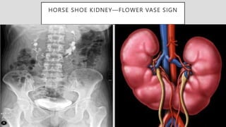 HORSE SHOE KIDNEY—FLOWER VASE SIGN
 