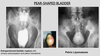 PEAR-SHAPED BLADDER
Extraperitoneal bladder rupture with
urinary extravasation and pelvic hematoma Pelvic Lipomatosis
 