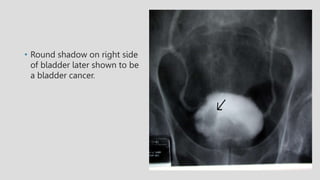 • Round shadow on right side
of bladder later shown to be
a bladder cancer.
 