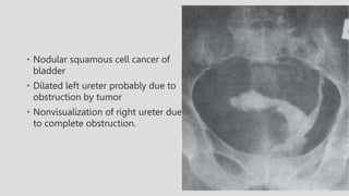 • Nodular squamous cell cancer of
bladder
• Dilated left ureter probably due to
obstruction by tumor
• Nonvisualization of right ureter due
to complete obstruction.
 