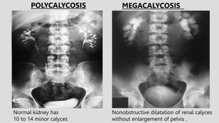 Normal kidney has
10 to 14 minor calyces
POLYCALYCOSIS MEGACALYCOSIS
Nonobstructive dilatation of renal calyces
without enlargement of pelvis .
 