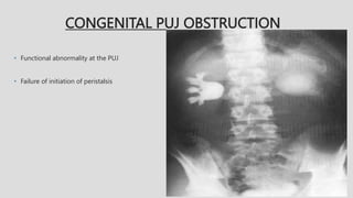 CONGENITAL PUJ OBSTRUCTION
• Functional abnormality at the PUJ
• Failure of initiation of peristalsis
 