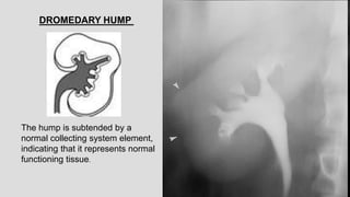 The hump is subtended by a
normal collecting system element,
indicating that it represents normal
functioning tissue.
DROM...