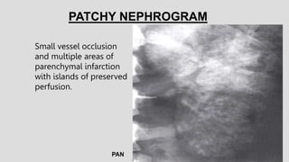 PAN
Small vessel occlusion
and multiple areas of
parenchymal infarction
with islands of preserved
perfusion.
PATCHY NEPHRO...