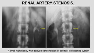 A small right kidney with delayed concentration of contrast in collecting system
RENAL ARTERY STENOSIS.
3 mts 15 mts
 