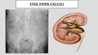 STAG HORN CALCULI
 