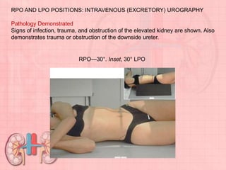 RPO AND LPO POSITIONS: INTRAVENOUS (EXCRETORY) UROGRAPHY
Pathology Demonstrated
Signs of infection, trauma, and obstruction of the elevated kidney are shown. Also
demonstrates trauma or obstruction of the downside ureter.
RPO—30°. Inset, 30° LPO
 