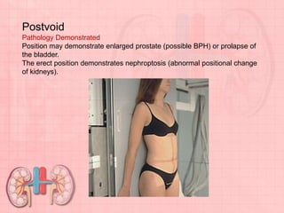 Postvoid
Pathology Demonstrated
Position may demonstrate enlarged prostate (possible BPH) or prolapse of
the bladder.
The erect position demonstrates nephroptosis (abnormal positional change
of kidneys).
 