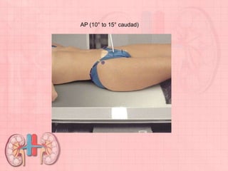 AP (10° to 15° caudad)
 