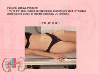 Posterior Oblique Positions:
• 45° to 60° body rotation. (Steep oblique positions are used to visualize
posterolateral aspect of bladder, especially UV junction.)
RPO (45° to 60°).
 