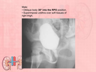 Male:
• Oblique body 30° into the RPO position.
• Superimpose urethra over soft tissues of
right thigh.
 