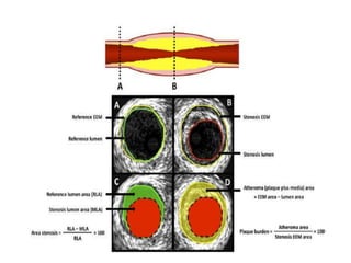Ivus | PPTX