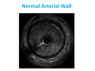 Ivus Normal Range Ivus | PPTX