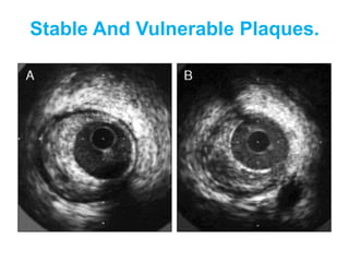 Stable And Vulnerable Plaques.
 