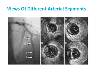 Ivus | PPTX