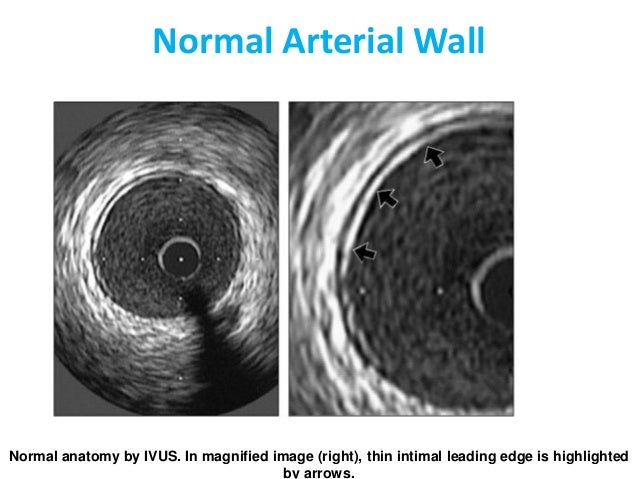 Intimal Plus Medial Thickness Of The Arterial Wall: A Direct ...