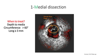 Ivus Disection IVUS Intravascular ultrasound made easy for intervention cardiologist | PDF