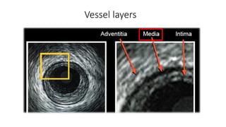 IVUS Intravascular ultrasound made easy for intervention cardiologist | PDF