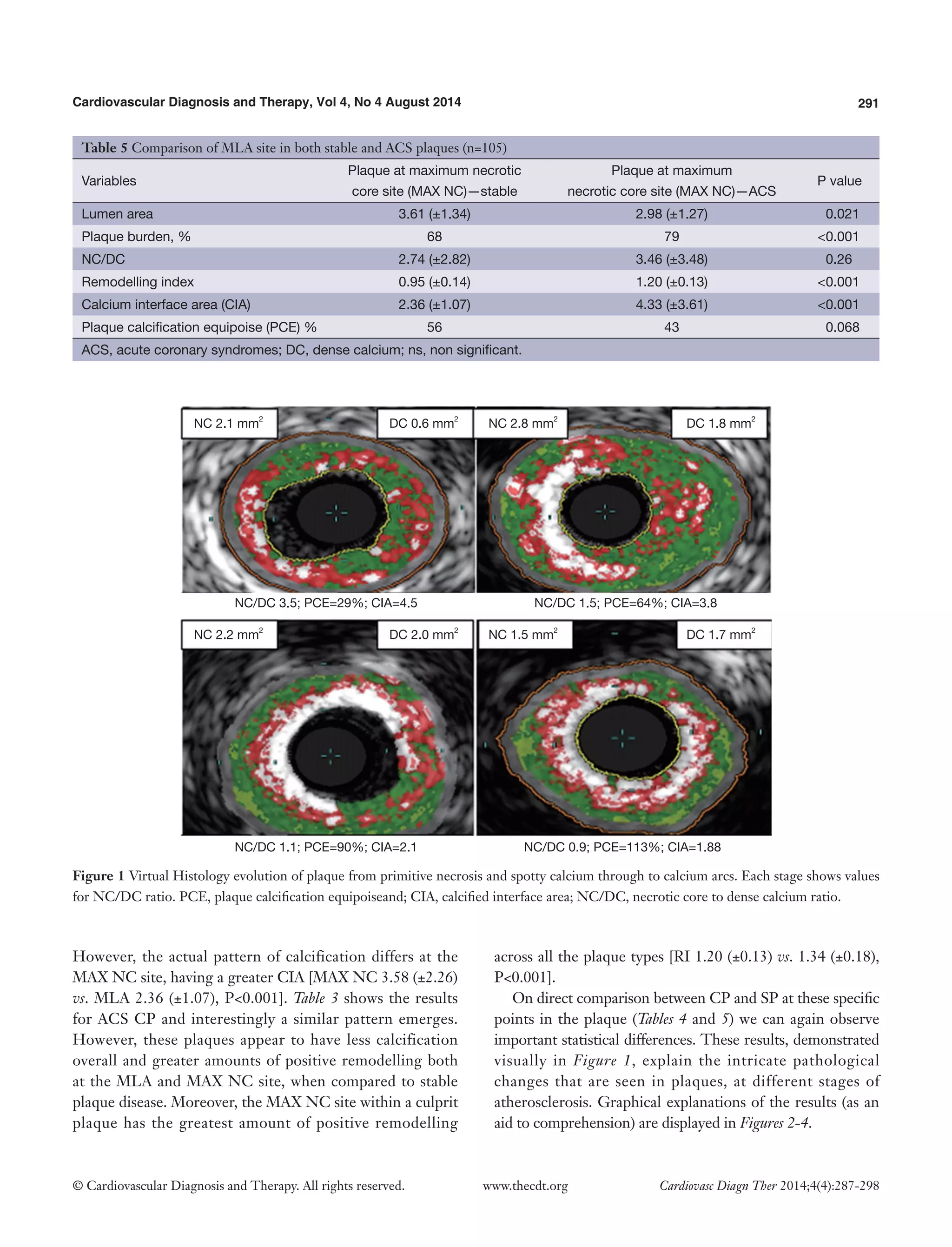 Cardiovascular Diagnosis and Therapy, Vol 4, No 4 August 2014 291 
© Cardiovascular Diagnosis and Therapy. All rights reserved. www.thecdt.org Cardiovasc Diagn Ther 2014;4(4):287-298 
However, the actual pattern of calcification differs at the MAX NC site, having a greater CIA [MAX NC 3.58 (±2.26) vs. MLA 2.36 (±1.07), P<0.001]. Table 3 shows the results for ACS CP and interestingly a similar pattern emerges. However, these plaques appear to have less calcification overall and greater amounts of positive remodelling both at the MLA and MAX NC site, when compared to stable plaque disease. Moreover, the MAX NC site within a culprit plaque has the greatest amount of positive remodelling across all the plaque types [RI 1.20 (±0.13) vs. 1.34 (±0.18), P<0.001]. 
On direct comparison between CP and SP at these specific points in the plaque (Tables 4 and 5) we can again observe important statistical differences. These results, demonstrated visually in Figure 1, explain the intricate pathological changes that are seen in plaques, at different stages of atherosclerosis. Graphical explanations of the results (as an aid to comprehension) are displayed in Figures 2-4. 
Table 5 Comparison of MLA site in both stable and ACS plaques (n=105) 
Variables 
Plaque at maximum necrotic 
core site (MAX NC)—stable 
Plaque at maximum 
necrotic core site (MAX NC)—ACS 
P value 
Lumen area 
3.61 (±1.34) 
2.98 (±1.27) 
0.021 
Plaque burden, % 
68 
79 
<0.001 
NC/DC 
2.74 (±2.82) 
3.46 (±3.48) 
0.26 
Remodelling index 
0.95 (±0.14) 
1.20 (±0.13) 
<0.001 
Calcium interface area (CIA) 
2.36 (±1.07) 
4.33 (±3.61) 
<0.001 
Plaque calcification equipoise (PCE) % 
56 
43 
0.068 
ACS, acute coronary syndromes; DC, dense calcium; ns, non significant. 
Figure 1 Virtual Histology evolution of plaque from primitive necrosis and spotty calcium through to calcium arcs. Each stage shows values for NC/DC ratio. PCE, plaque calcification equipoiseand; CIA, calcified interface area; NC/DC, necrotic core to dense calcium ratio. 
NC 2.1 mm2 
NC 2.2 mm2 
NC 1.5 mm2 
NC 2.8 mm2 
DC 0.6 mm2 
NC/DC 3.5; PCE=29%; CIA=4.5 
NC/DC 1.1; PCE=90%; CIA=2.1 
NC/DC 0.9; PCE=113%; CIA=1.88 
NC/DC 1.5; PCE=64%; CIA=3.8 
DC 1.8 mm2 
DC 1.7 mm2 
DC 2.0 mm2  