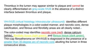 Thrombus in the lumen may appear similar to plaque and cannot be
clearly differentiated on gray-scale IVUS in the absence of a distinct
interface between thrombus and plaque.
VH-IVUS (virtual histology intravascular ultrasound) identifies different
plaque morphologies in a color-coded manner, and necrotic core, dense
calcification, and fibrous and fibrofatty areas are all clearly noted.78
The color-coded map identifies necrotic core (red), dense calcium
(white), fibrofatty tissue (light green), and fibrous tissue (dark green).
Thin-cap fibroatheroma on VH-IVUS is diagnosed in the presence of a
greater than 30-degree arc of necrotic core abutting the lumen in three
consecutive slices.
 