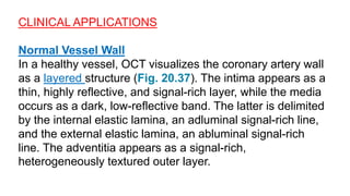CLINICAL APPLICATIONS
Normal Vessel Wall
In a healthy vessel, OCT visualizes the coronary artery wall
as a layered structure (Fig. 20.37). The intima appears as a
thin, highly reflective, and signal-rich layer, while the media
occurs as a dark, low-reflective band. The latter is delimited
by the internal elastic lamina, an adluminal signal-rich line,
and the external elastic lamina, an abluminal signal-rich
line. The adventitia appears as a signal-rich,
heterogeneously textured outer layer.
 