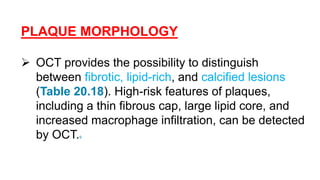 PLAQUE MORPHOLOGY
 OCT provides the possibility to distinguish
between fibrotic, lipid-rich, and calcified lesions
(Table 20.18). High-risk features of plaques,
including a thin fibrous cap, large lipid core, and
increased macrophage infiltration, can be detected
by OCT.9
 